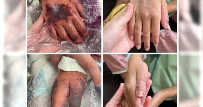 Cơ thể xuất hiện nhiều vết bầm tím lớn, đây là một trong những triệu chứng rõ rệt cho thấy bạn đang bị mắc vi khuẩn ăn thịt người. (Ảnh: Tổng hợp)