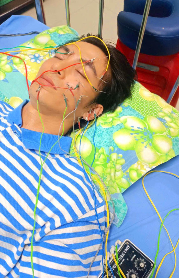 Diễn viên Lãnh Thanh tích cực điều trị sau khi được chẩn đoán liệt dây thần kinh số 7. (Ảnh: FBNV)