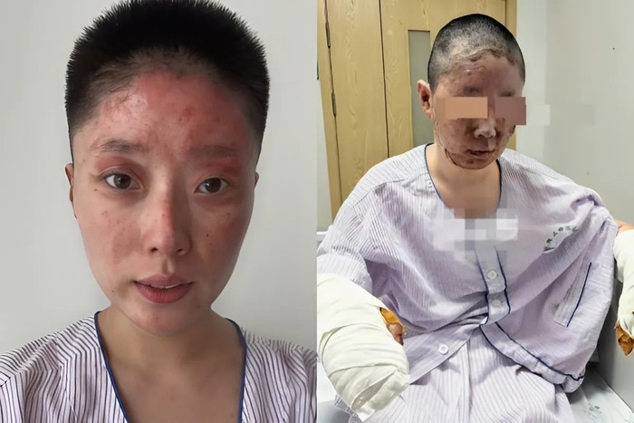 Nữ người mẫu Đồng Dao chia sẻ hình ảnh sau vụ bị bỏng do rò rỉ khí gas. (Ảnh ETtoday)