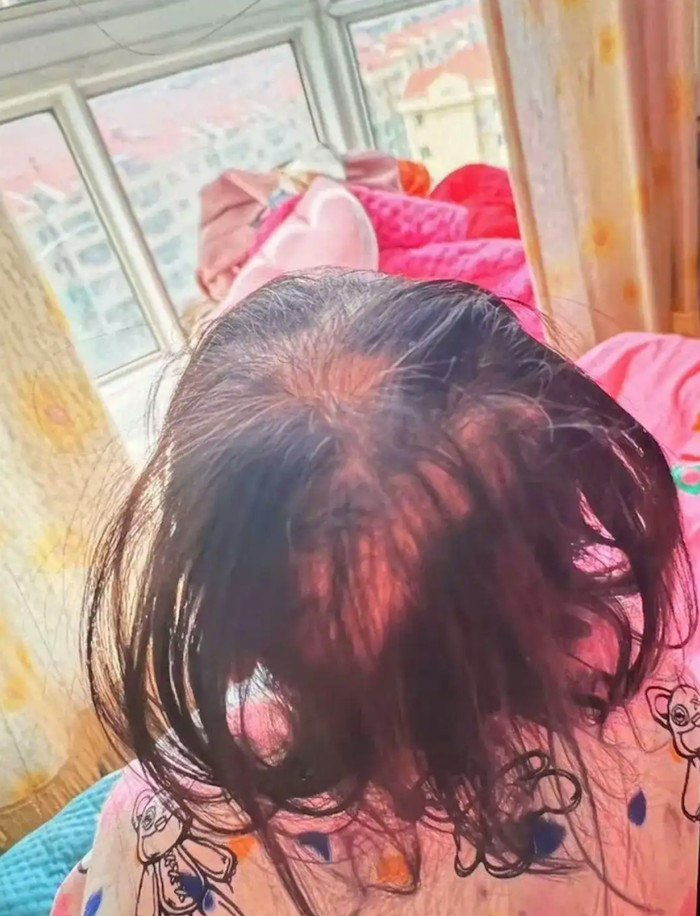 Bé gái 3 tuổi bị đầu độc bằng thallium khiến tóc rụng gần hết đầu Ảnh 1