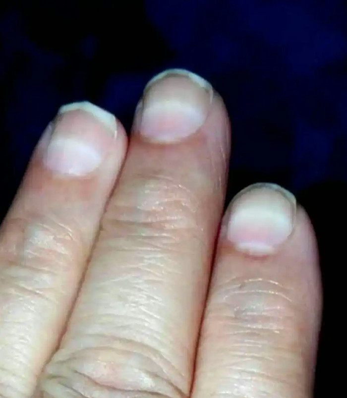 Bé gái 3 tuổi bị đầu độc bằng thallium khiến tóc rụng gần hết đầu Ảnh 2