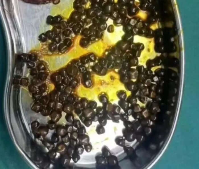 Bé gái này trước khi bị sỏi mật đã thói quen không ăn sáng trong một thời gian dài. Ảnh: Sohu