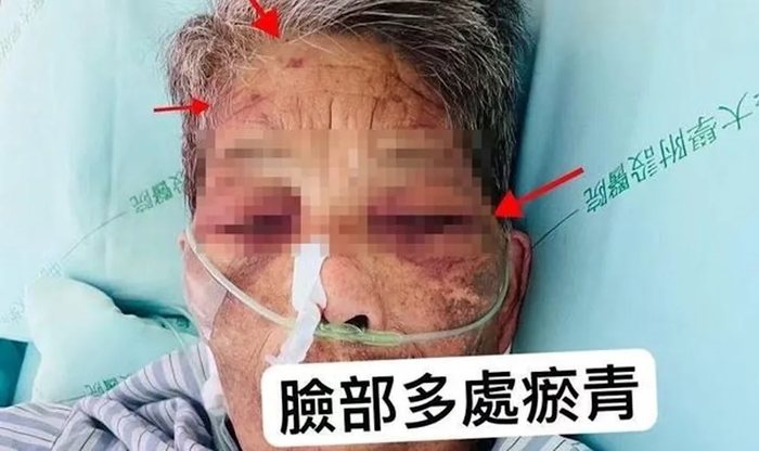 Cụ bà 85 tuổi bầm tím khắp người, gia đình rơi nước mắt khi kiểm tra camera Ảnh 2