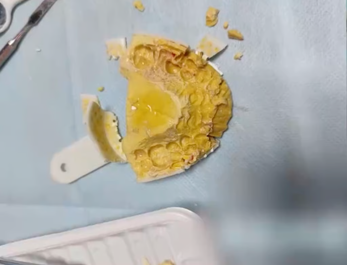 Tự làm hàm duy trì tại nhà, cô gái 24 tuổi gặp nguy hiểm đến tính mạng Ảnh 2