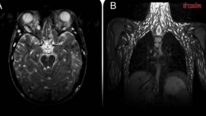 Ăn rau sống, cô gái bị sán dây lợn 'xâm chiếm' cơ thể Ảnh 1