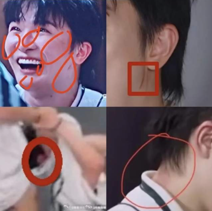Diễn viên Châu Thâm đã bị thương sau màn kéo lê khi tham gia một chương trình. Ảnh: 163