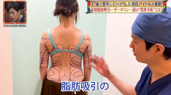 Bác sĩ đánh dấu các vùng khác nhau trên lưng MiRichan, và các vùng được đánh dấu bằng bút đỏ là nơi sẽ tiến hành hút mỡ.