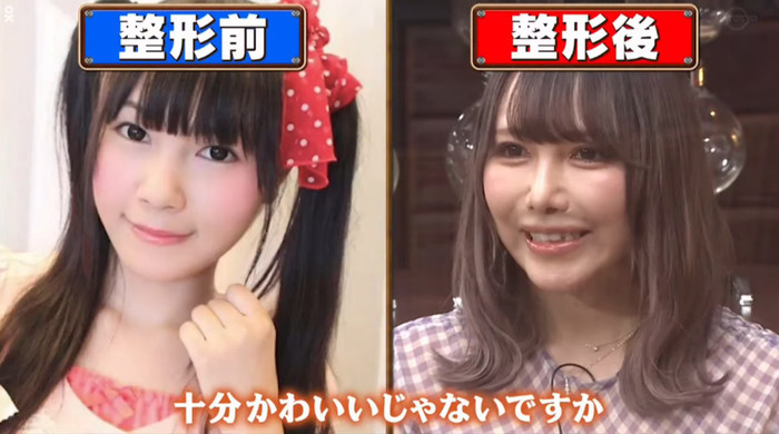 Bên trái là trước khi phẫu thuật, bên phải là diện mạo hiện tại của cô sau khi phẫu thuật.