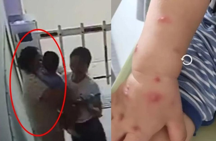 Bé trai 1 tuổi nhiễm bệnh sau khi bị hàng xóm hôn vào má Ảnh 1