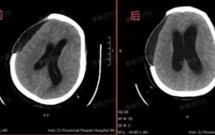 Cụ bà 67 tuổi phẫu thuật não khẩn cấp sau khi tắm nắng giữa trưa Ảnh 2