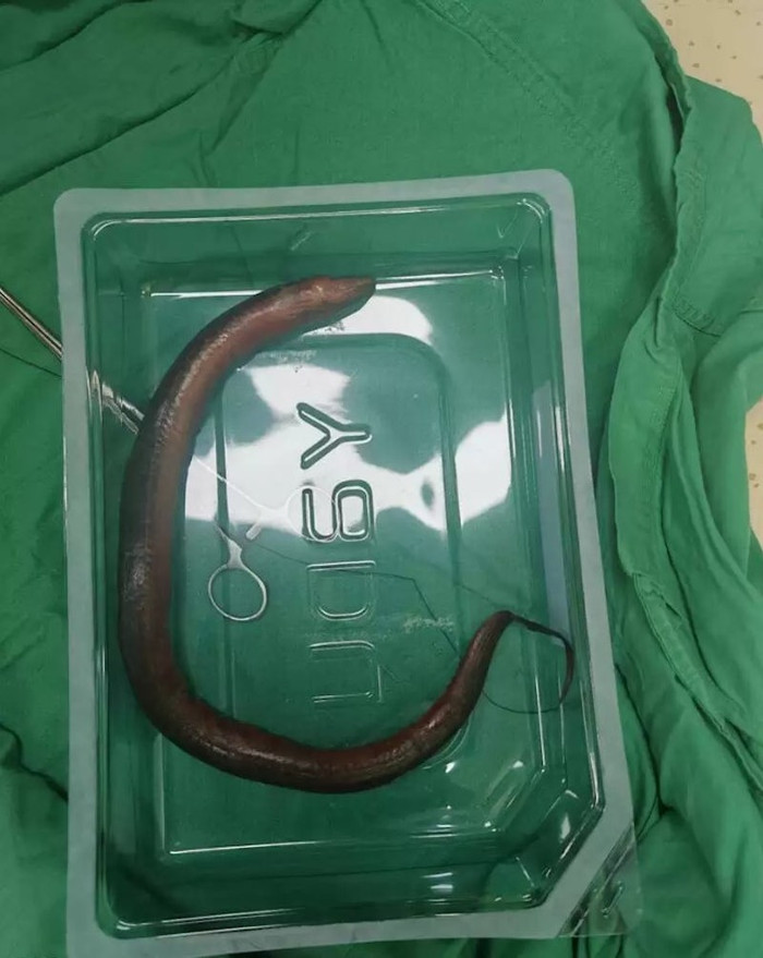 Con lươn 30cm chui vào bụng đâm thủng ruột người đàn ông, bác sĩ toát mồ hôi khi lấy ra Ảnh 2