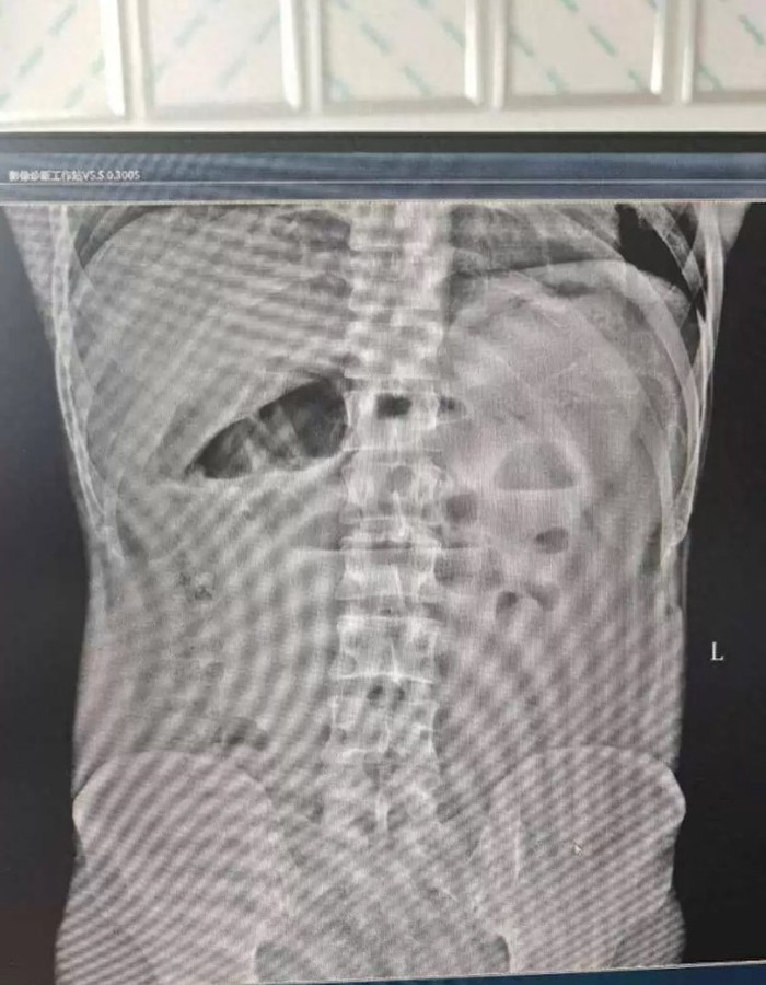 Con lươn 30cm chui vào bụng đâm thủng ruột người đàn ông, bác sĩ toát mồ hôi khi lấy ra Ảnh 1