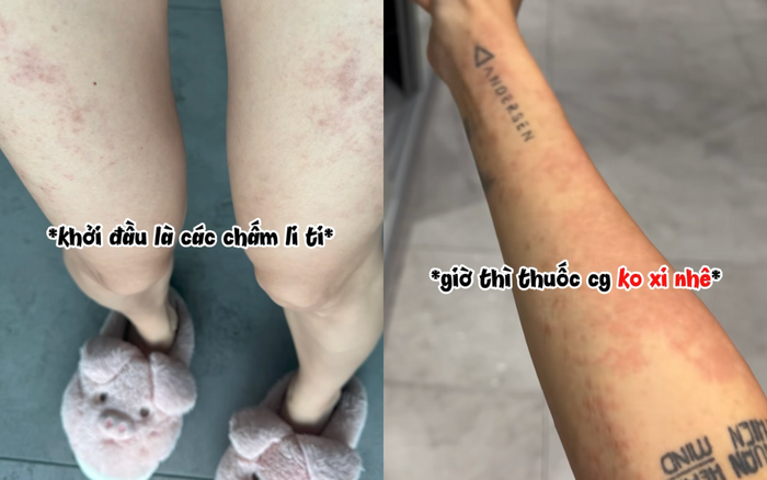 Những vết phát ban khiến Ngô Thanh Vân mệt mỏi cả về thể chất lẫn tinh thần. Ảnh: FBNV