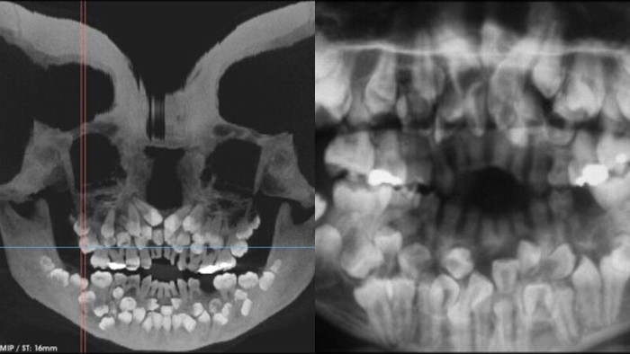 Bé gái 11 tuổi mọc 81 chiếc răng Ảnh 1