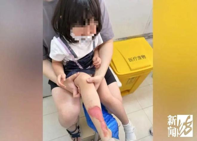 Ấm nước sôi bị gãy quai làm bé gái 3 tuổi bị bỏng nặng, nhà hàng xử lý gây bức xúc Ảnh 4