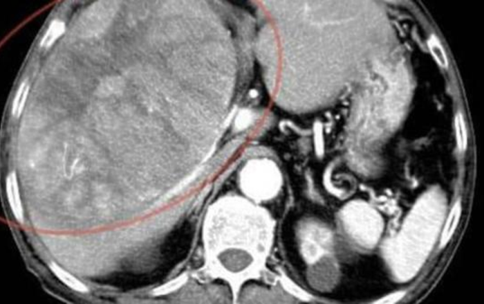 Ăn uống quá lành mạnh, cụ ông ngoài 80 tuổi mắc ung thư gan giai đoạn cuối Ảnh 2