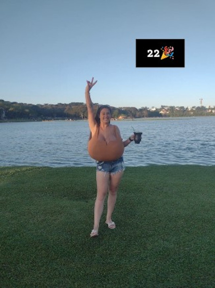 Cô gái mắc bệnh lạ khiến ngực to ra khổng lồ, nặng đến 12 ký Ảnh 1