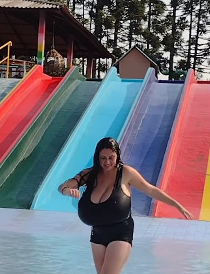 Cô gái mắc bệnh lạ khiến ngực to ra khổng lồ, nặng đến 12 ký Ảnh 3