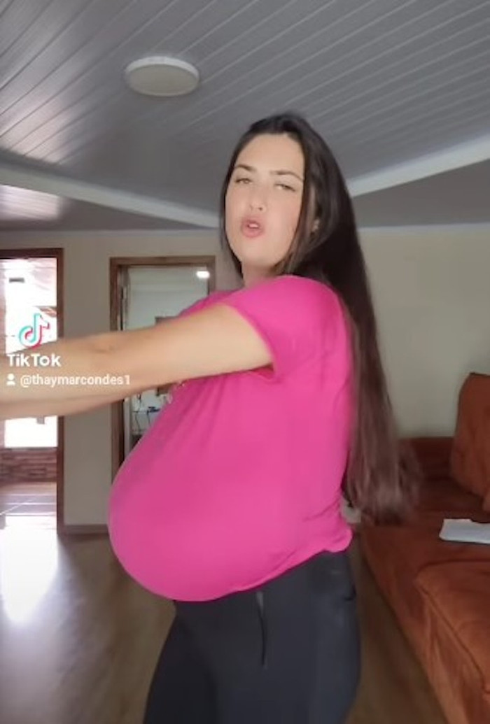 Cô gái mắc bệnh lạ khiến ngực to ra khổng lồ, nặng đến 12 ký Ảnh 2