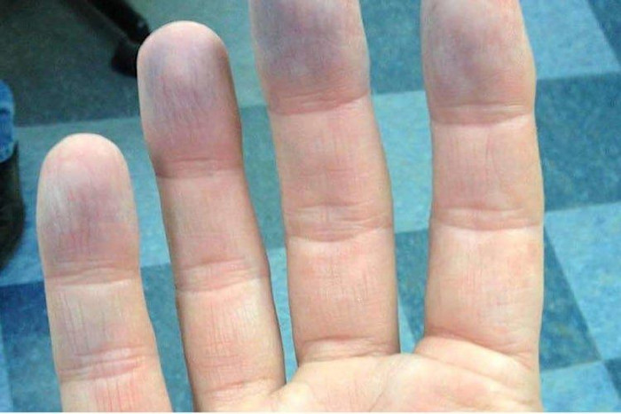 5 dấu hiệu trên bàn tay cảnh báo nguy cơ bệnh phổi, nên bổ sung dinh dưỡng ra sao? Ảnh 5