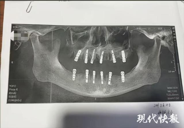 Cụ ông 77 tuổi tử vong sau khi cấy 6 implant và nhổ 12 răng Ảnh 1
