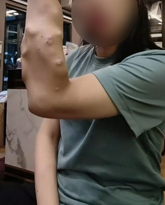 Cánh tay của cô gái bị suy thận giai đoạn cuối sau nhiều lần lọc máu.