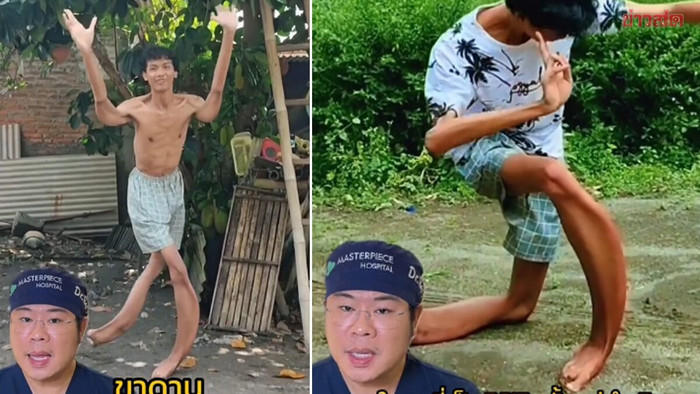 Chàng trai mắc căn bệnh từ trong bụng mẹ, đôi chân biến dạng như thanh kiếm gây ngỡ ngàng Ảnh 1