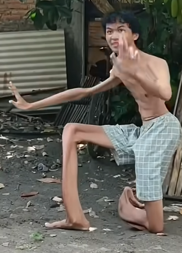 Chàng trai mắc căn bệnh từ trong bụng mẹ, đôi chân biến dạng như thanh kiếm gây ngỡ ngàng Ảnh 2