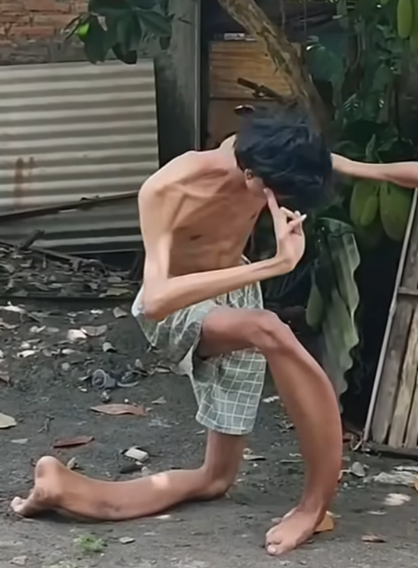 Chàng trai mắc căn bệnh từ trong bụng mẹ, đôi chân biến dạng như thanh kiếm gây ngỡ ngàng Ảnh 3