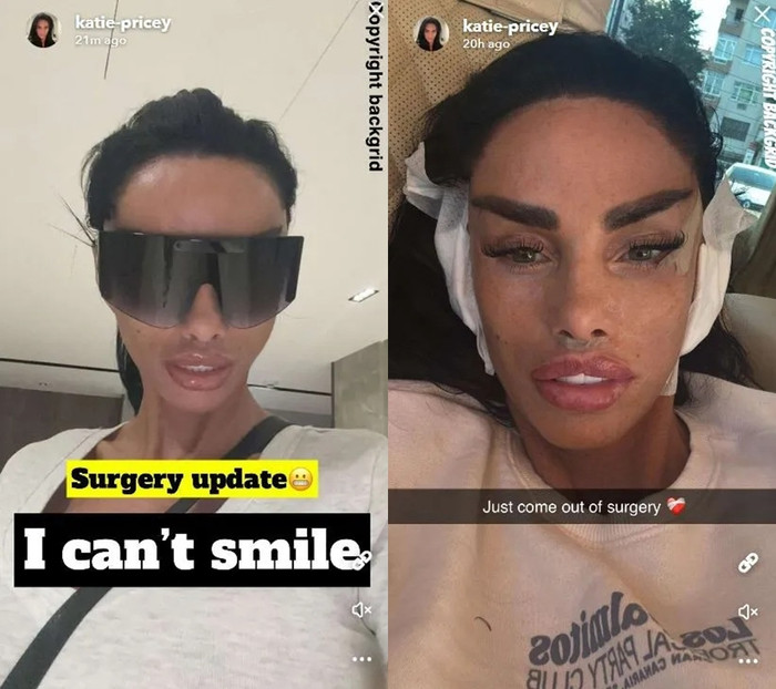 Nữ người mẫu cho biết cô vừa phẫu thuật thẩm mỹ, hiện không thể cười. (Ảnh The Scottish Sun)