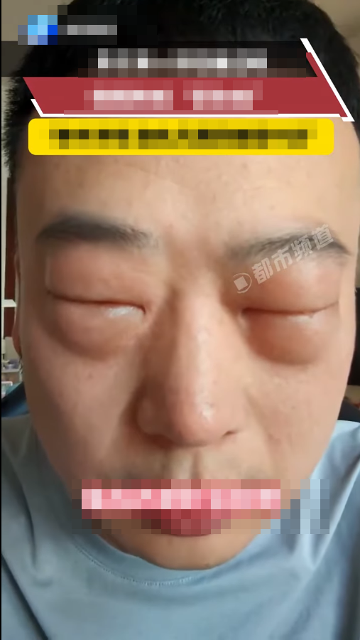 Người đàn ông sưng húp đôi mắt, không thể mở lên sau khi thử một món ăn Ảnh 2