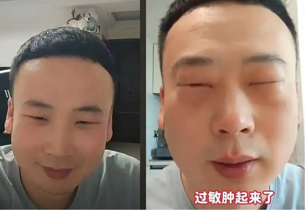 Người đàn ông sưng húp đôi mắt, không thể mở lên sau khi thử một món ăn Ảnh 1