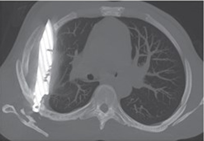 Ngực liên tục chảy ra chất dịch, người đàn ông đi bệnh viện thì phát hiện bí mật kinh hoàng suốt 8 năm Ảnh 3