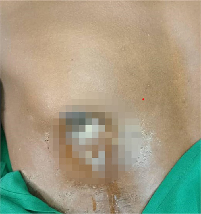 Ngực liên tục chảy ra chất dịch, người đàn ông đi bệnh viện thì phát hiện bí mật kinh hoàng suốt 8 năm Ảnh 1