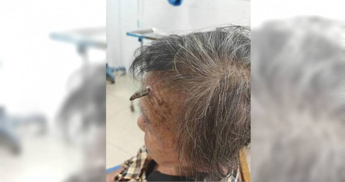 Xôn xao cụ bà 98 tuổi mọc 'sừng' dài trên trán, nguy kịch sau khi tự cắt bỏ Ảnh 1