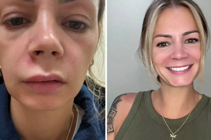 Người phụ nữ gặp nguy hiểm chỉ vì tự ý nặn mụn. Ảnh: Jam Press