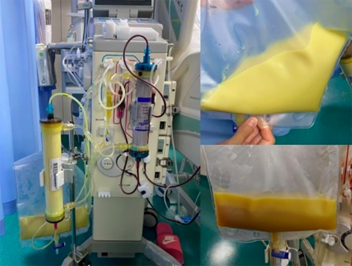 Bệnh nhân có máu trắng đục như sữa. (Nguồn: QQ News)