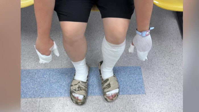 Người đàn ông bị bỏng cấp độ hai toàn thân khi sử dụng thuốc xịt côn trùng Ảnh 2