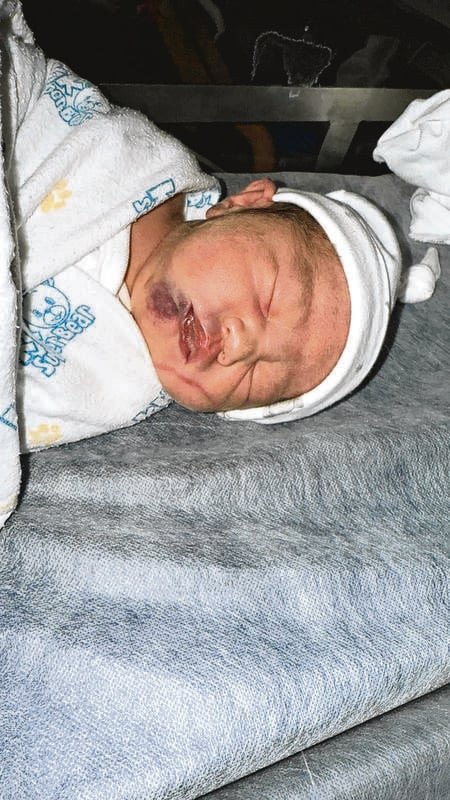 Khuôn mặt bé trai bầm tím nghiêm trọng sau khi sinh, cha mẹ đau lòng Ảnh 1