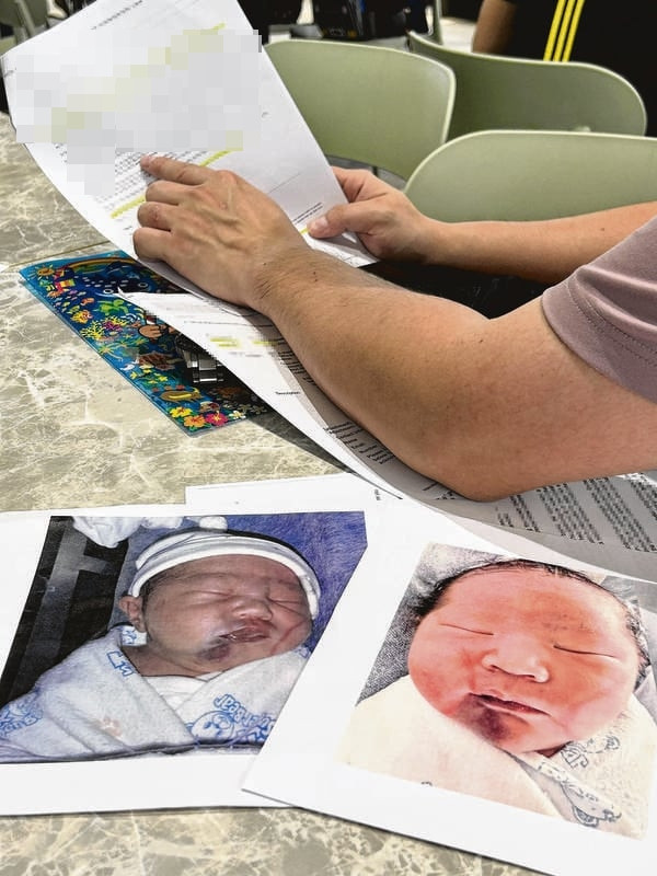 Khuôn mặt bé trai bầm tím nghiêm trọng sau khi sinh, cha mẹ đau lòng Ảnh 2