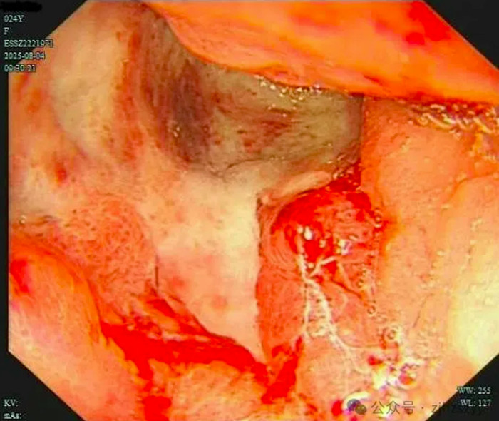 Nữ diễn viên nôn ra máu khi đang quay phim, nhập viện khẩn cấp thì phát hiện bị ung thư dạ dày Ảnh 1