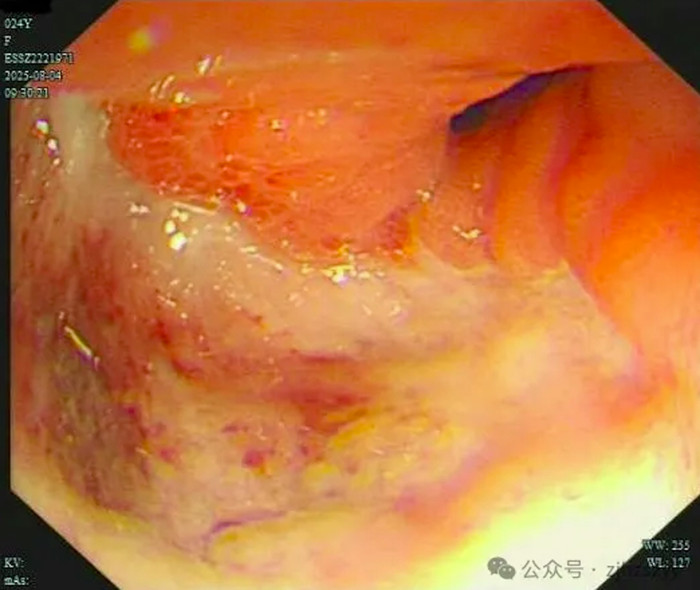 Nữ diễn viên nôn ra máu khi đang quay phim, nhập viện khẩn cấp thì phát hiện bị ung thư dạ dày Ảnh 2
