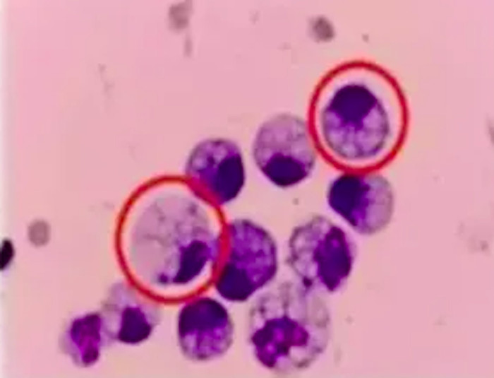 Nữ diễn viên nôn ra máu khi đang quay phim, nhập viện khẩn cấp thì phát hiện bị ung thư dạ dày Ảnh 3