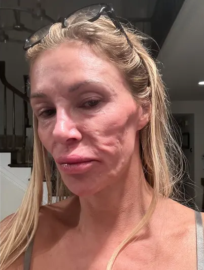 Brandi Glanville bị biến dạng mặt vì căn bệnh bí ẩn mà cô nghi là do ký sinh trùng. (Ảnh: Brandi Glanville)