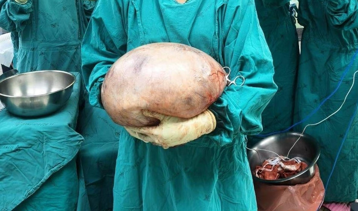 Bác sĩ cắt bỏ thành công khối u nang buồng trứng nặng 8 ký của bệnh nhân, nhìn ảnh ai cũng 'tái mặt' Ảnh 2