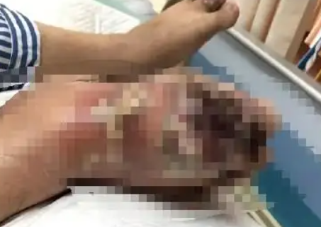 Uống ba lon nước ngọt mỗi ngày trong nhiều năm, người đàn ông 31 tuổi gặp tình trạng kinh hoàng ở bàn chân Ảnh 2