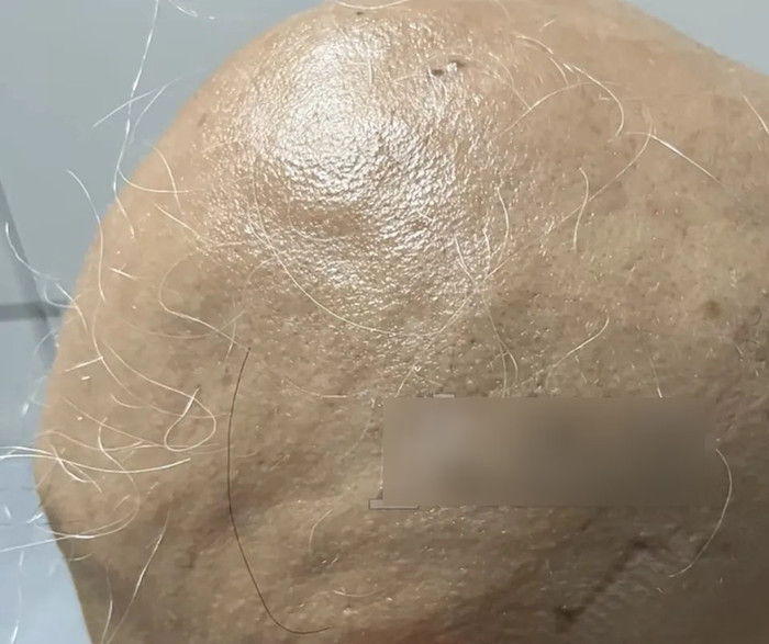 Cô gái 20 tuổi bị rụng gần hết tóc và lông mày chỉ trong vòng 1 tháng. (Ảnh từ QQ)