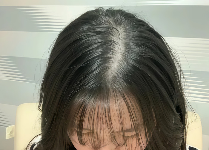 Căng thẳng kéo dài có thể gây ra tình trạng rụng tóc. (Ảnh minh họa từ Zhihu)