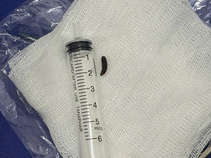 Con giòi sống trong ống tai của bệnh nhi 14 tháng tuổi. (Nguồn: Báo Sức khỏe và Đời sống)