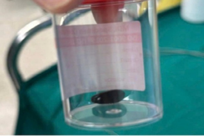 Hạt mãng cầu được bác sĩ gắp ra an toàn bằng dụng cụ chuyên dụng. (Nguồn: Tạp chí Tri thức)